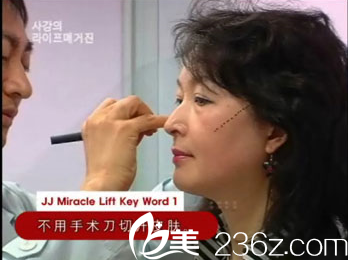 美來可整形醫(yī)院面部提升術(shù)無需動(dòng)刀 美來可整形醫(yī)院面部提升術(shù)無需動(dòng)刀