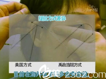 美來可整形醫(yī)院禹政浩先進(jìn)的提拉方式 美來可整形醫(yī)院禹政浩先進(jìn)的提拉方式