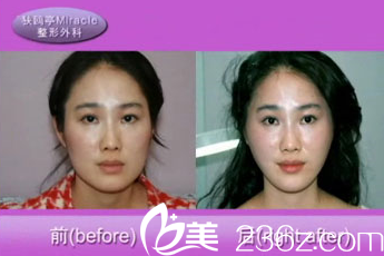 美來可整形醫(yī)院禹政浩面部提升術(shù)效果對(duì)比 美來可整形醫(yī)院禹政浩面部提升術(shù)效果對(duì)比
