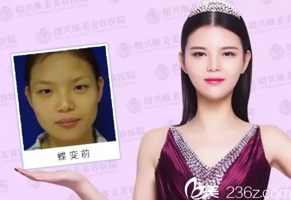 術(shù)前術(shù)后的效果對(duì)比圖