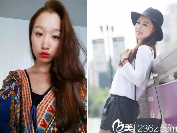 紹興維美李杰主任的美膚真人案例 紹興維美李杰主任的美膚真人案例