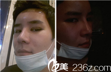 德萊茵整形外科真人案例兩周記錄