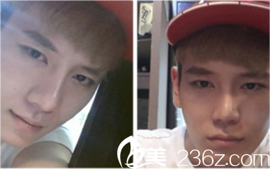 鄭裕錫院長(zhǎng)手術(shù)真人案例術(shù)后四個(gè)月