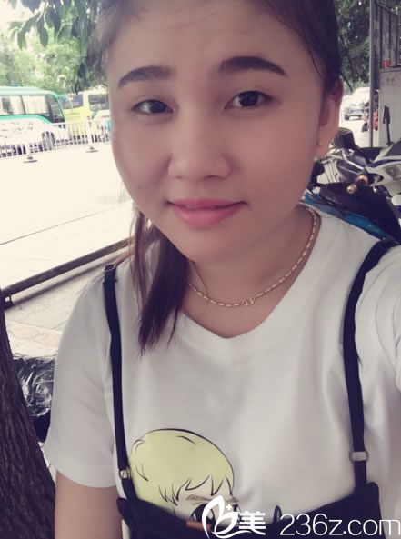 在維美做韓式雙眼皮手術(shù)前 在維美做韓式雙眼皮手術(shù)前