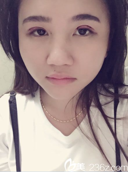 紹興維美汪峰韓式三點(diǎn)雙眼皮第1天 紹興維美汪峰韓式三點(diǎn)雙眼皮第1天