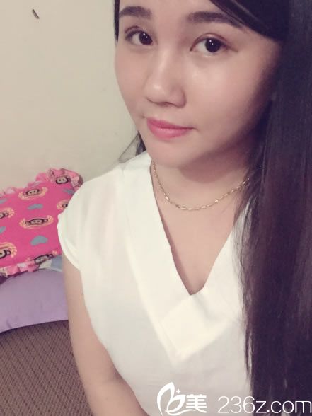 維美做韓式雙眼皮第6天恢復(fù)照 維美做韓式雙眼皮第6天恢復(fù)照