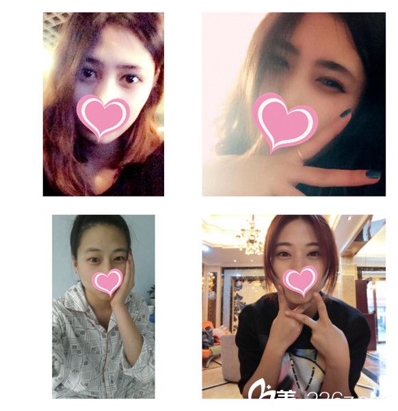 張新枝主任做雙眼皮案例 張新枝主任做雙眼皮案例