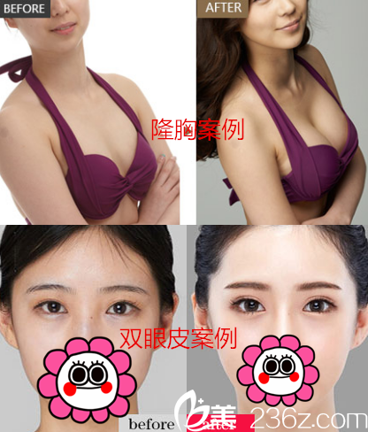 重慶華美李富強(qiáng)院長(zhǎng)真人隆胸雙眼皮案例