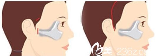 韓國美姿整形外科醫(yī)院顴骨降低術(shù)