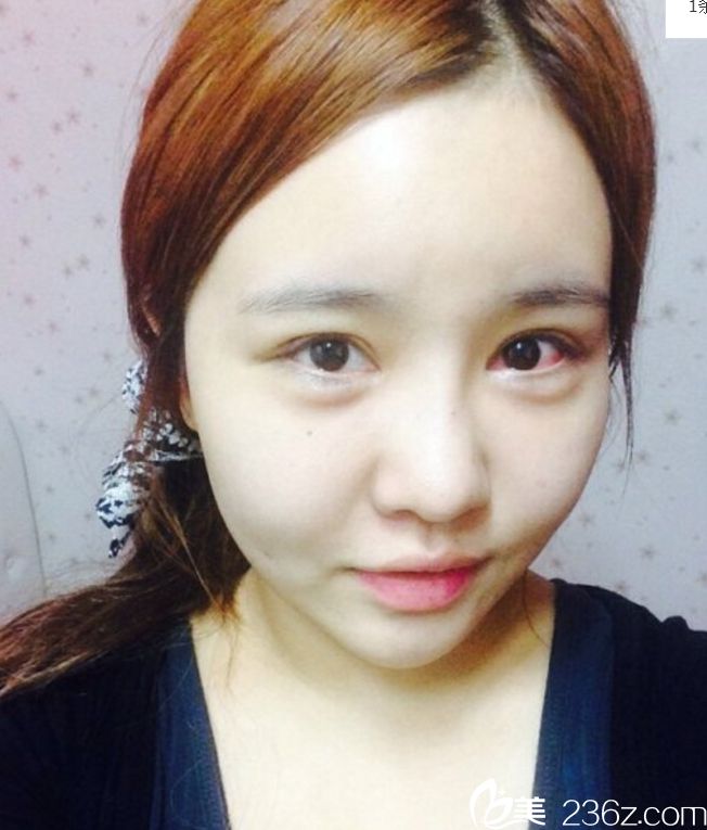 柳元敏雙眼皮修復(fù)真人案例