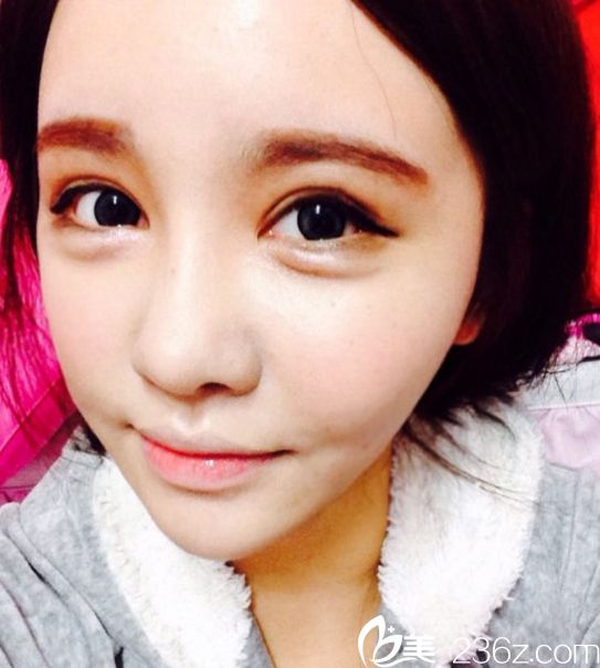 韓國(guó)美佳整形美容醫(yī)院柳元敏院長(zhǎng)雙眼皮修復(fù)真人案例