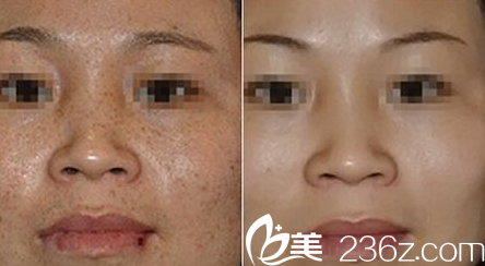 重慶華美王繼文醫(yī)生祛斑真人案例 重慶華美王繼文醫(yī)生祛斑真人案例