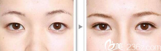 韓國(guó)伊美芝整形真人案例 韓國(guó)伊美芝整形真人案例