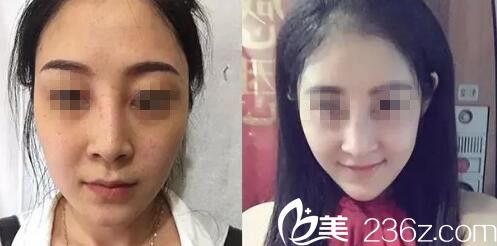 韓國美麗世界整形外科基做鼻子效果好不好？膨體隆鼻真人案例