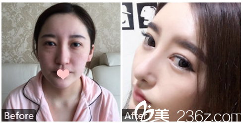 <!--<i data=20240703-sp></i>-->整形<!--<i data=20240703-sp></i>-->肋軟骨隆鼻案例