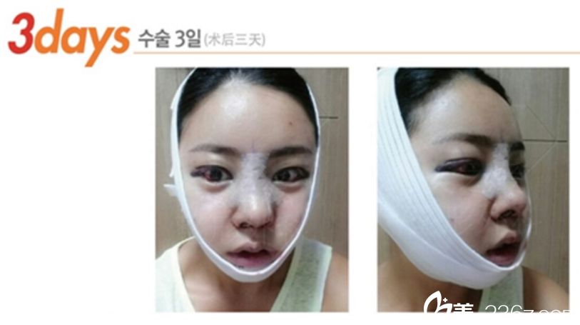 沈炯坤院長顴骨+V-line手術(shù)真人案例