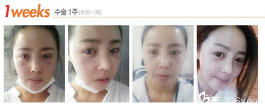 美之愛沈炯坤鼻整形 雙眼皮真人案例