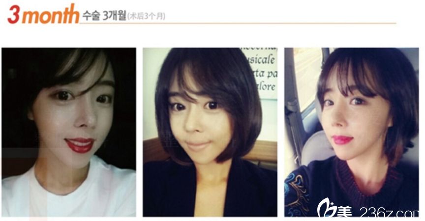 美之愛整形外科沈炯坤院長技術(shù)怎么樣？顴骨+V-line手術(shù)+鼻修復(fù)+開眼角提肌真人案例