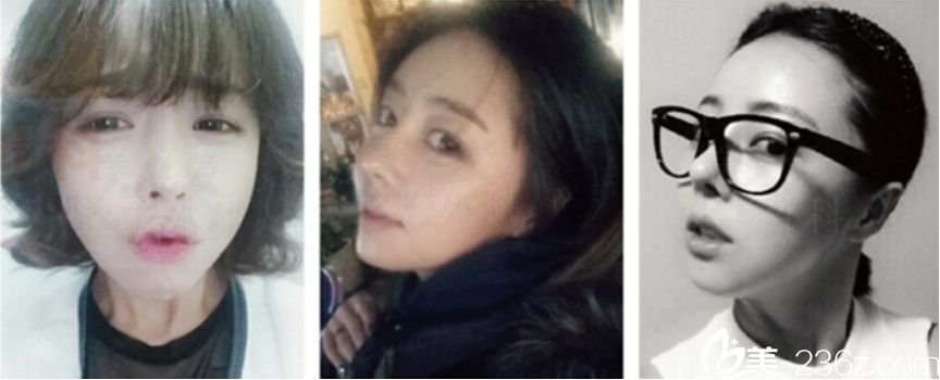 美之愛整形外科沈炯坤院長技術(shù)怎么樣？顴骨+V-line手術(shù)+鼻修復(fù)+開眼角提肌真人案例