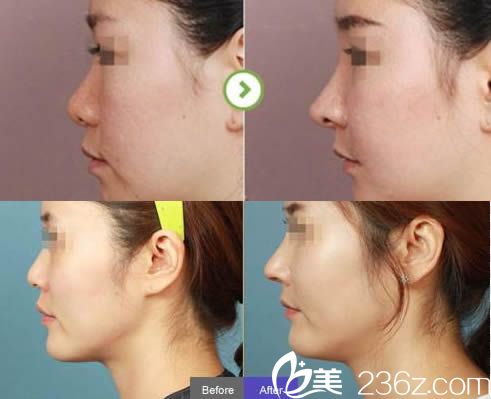 王煥主任假體隆鼻前后對(duì)比效果