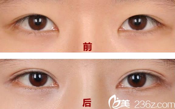 王煥切開雙眼皮案例圖