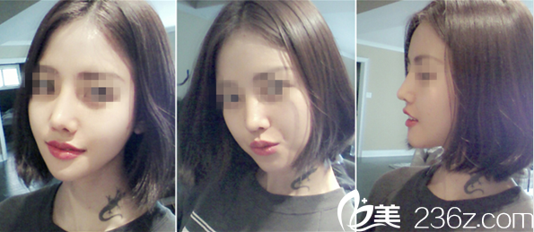 分享我在A特整形中心做鼻+面部輪廓整形過程，金漢祚院長案例