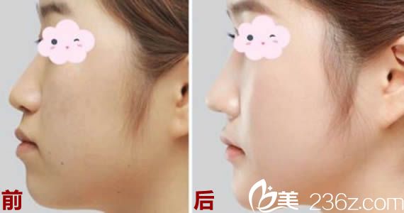 呼市五洲整形王煥主任鼻綜合案例