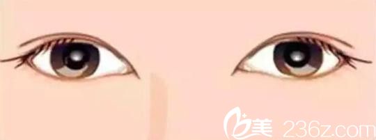 外寬內窄的雙眼皮