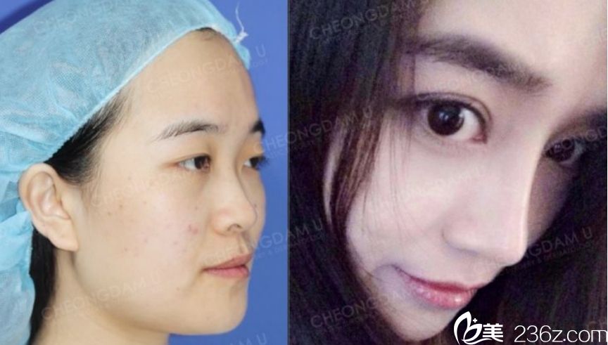 真人案例對比 韓國清潭優(yōu)整形外科隆鼻