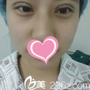 剛做完雙眼皮手術(shù)的樣子