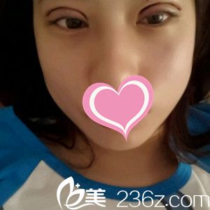 雙眼皮術(shù)后3天眼睛依然腫脹