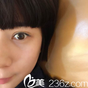 做雙眼皮20天恢復(fù)情況