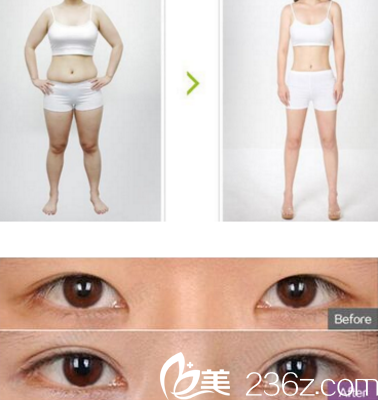 臨汾麗都金平吸脂雙眼皮案例 臨汾麗都金平吸脂雙眼皮案例