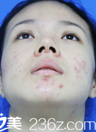 鼻綜合術(shù)前 鼻綜合術(shù)前