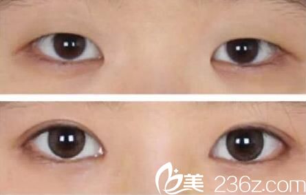 韓國綺林整形外科開內(nèi)眼角案例 韓國綺林整形外科開內(nèi)眼角案例