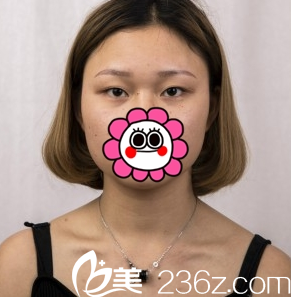 臨汾麗都金平全切雙眼皮案例術(shù)前圖 臨汾麗都金平全切雙眼皮案例術(shù)前圖