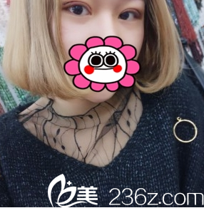 雙眼皮案例1周照臨汾麗都 雙眼皮案例1周照臨汾麗都