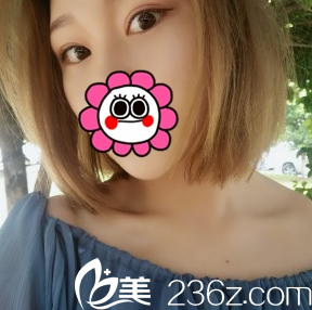 看我找臨汾麗都金平割的全切雙眼皮好看嗎?整形3個月效果圖展示