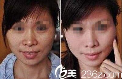 韓國(guó)清潭洞MIN CLINIC微整形外科閔永修祛斑效果好不好？激光祛斑真人案例