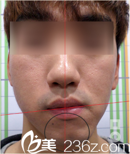 韓國美爾韓整形醫(yī)院顏面不對稱真人矯正前 韓國美爾韓整形醫(yī)院顏面不對稱真人矯正前