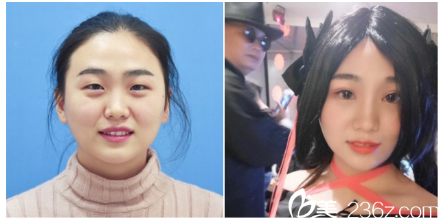 桂林華美游海鋒雙眼皮案例對比圖