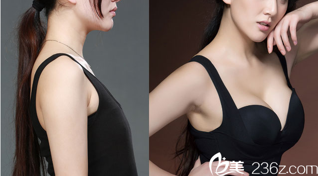 桂林華美趙麗紅隆胸案例對比效果圖