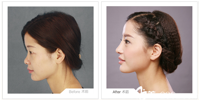 桂林華美游海鋒隆鼻案例前后效果圖