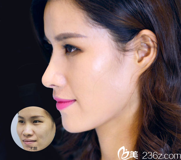 桂林華美胡凱隆鼻案例對比圖