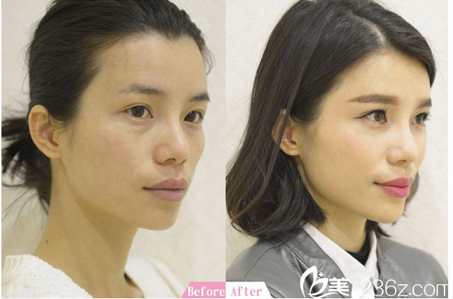 桂林華美劉真俊玻尿酸注射案例