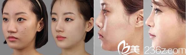 <!--<i data=20240703-sp></i>-->鼻綜合隆鼻案例圖 <!--<i data=20240703-sp></i>-->鼻綜合隆鼻案例圖