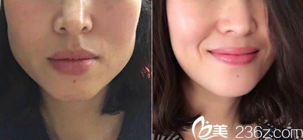 崔鯪鯉主任注射瘦臉案例 崔鯪鯉主任注射瘦臉案例