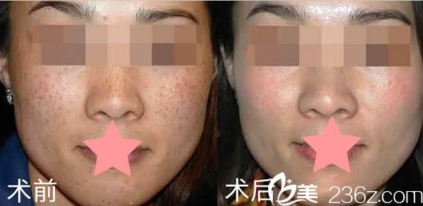 崔鯪鯉激光祛斑前后對比效果圖 崔鯪鯉激光祛斑前后對比效果圖