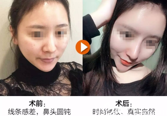 重慶美侖美奐整形施問國隆鼻案例 重慶美侖美奐整形施問國隆鼻案例