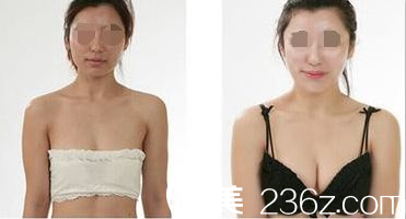 第四<!--<i data=20240703-sp></i>--><!--<i data=20240703-sp></i>-->醫(yī)院整形科隆胸術(shù)后